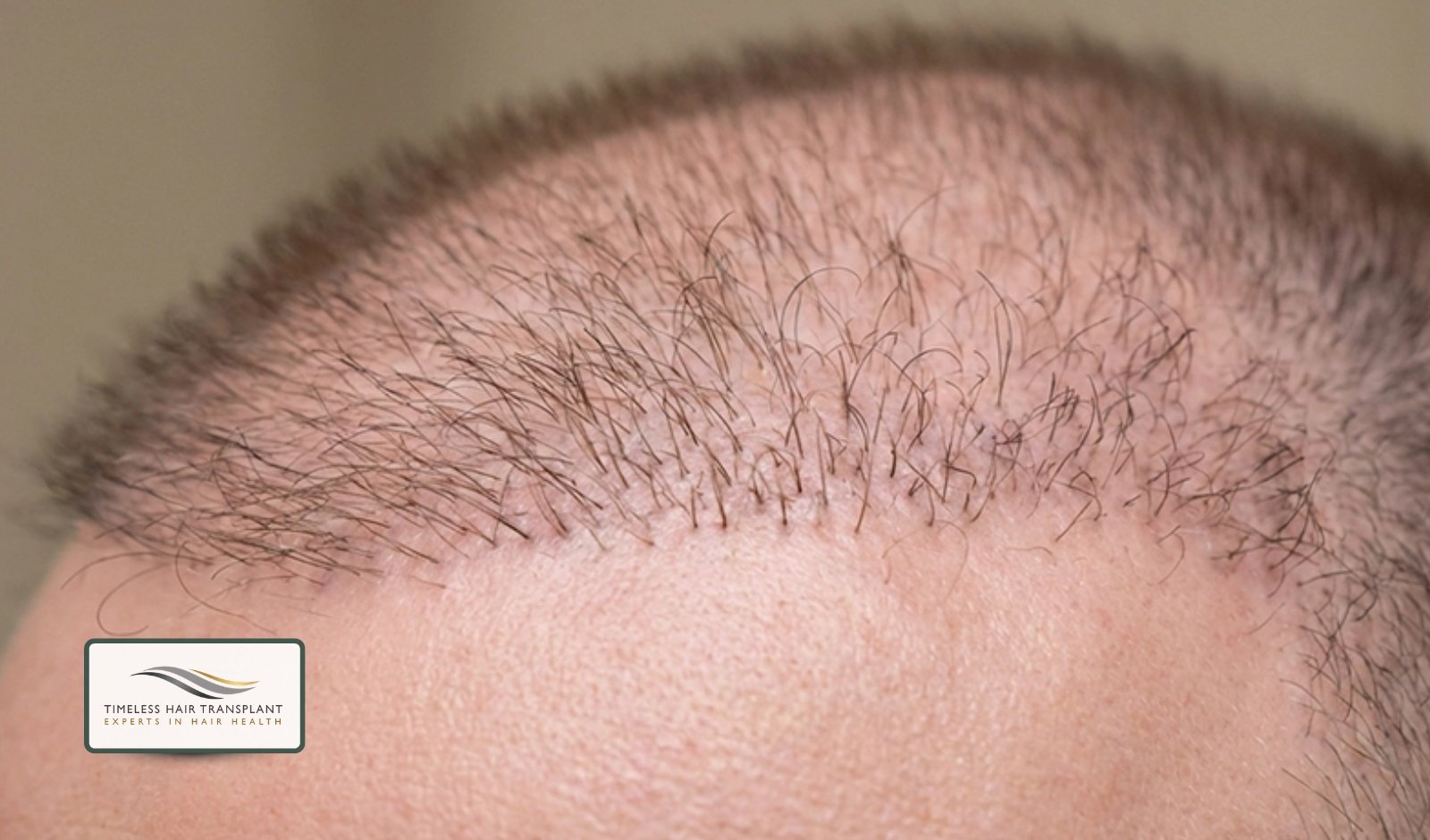 Months 3 to 4 Early Hair Growth