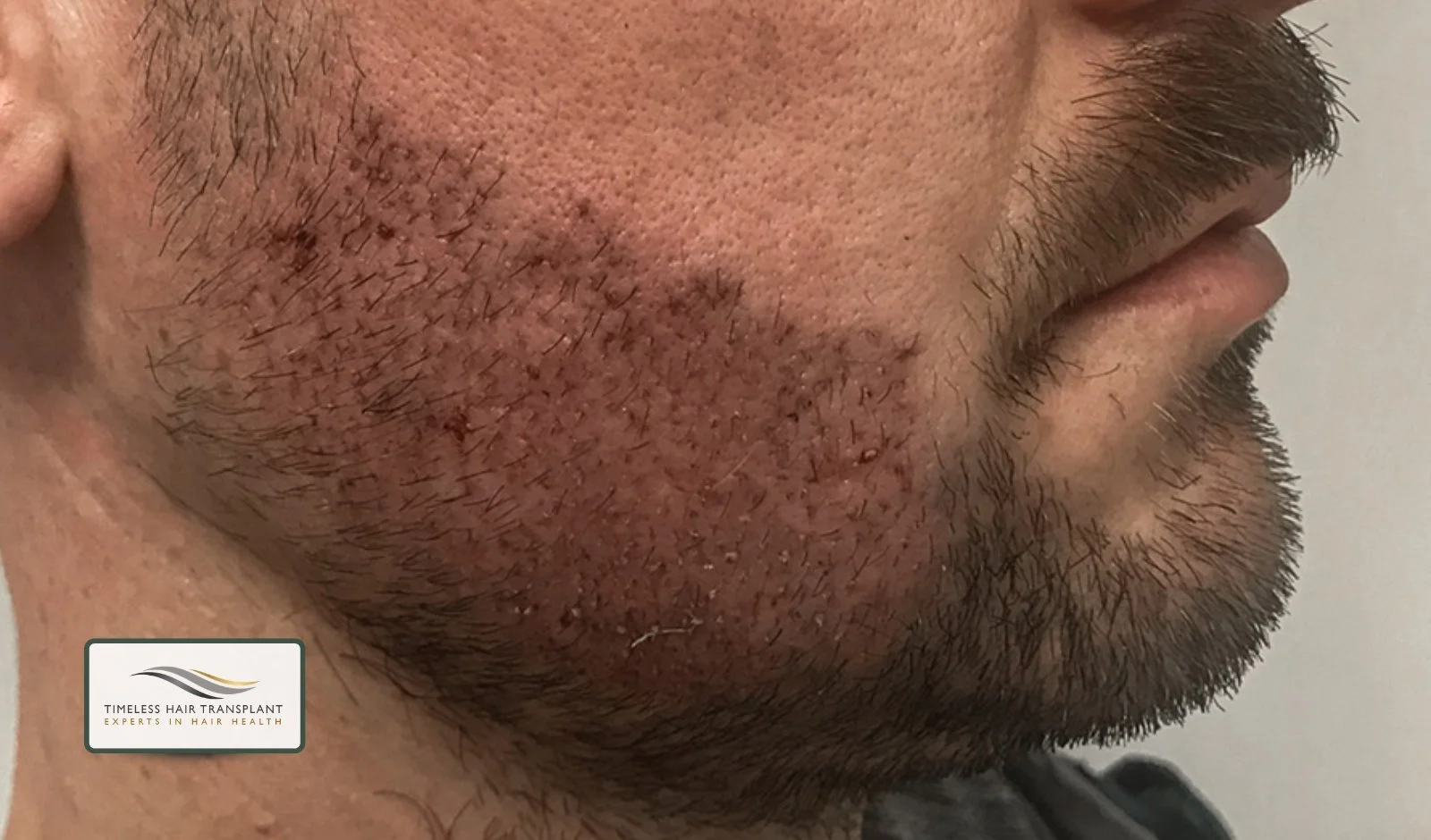 Shock Loss and Shedding