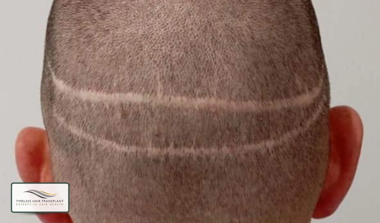 FUT Hair Transplant