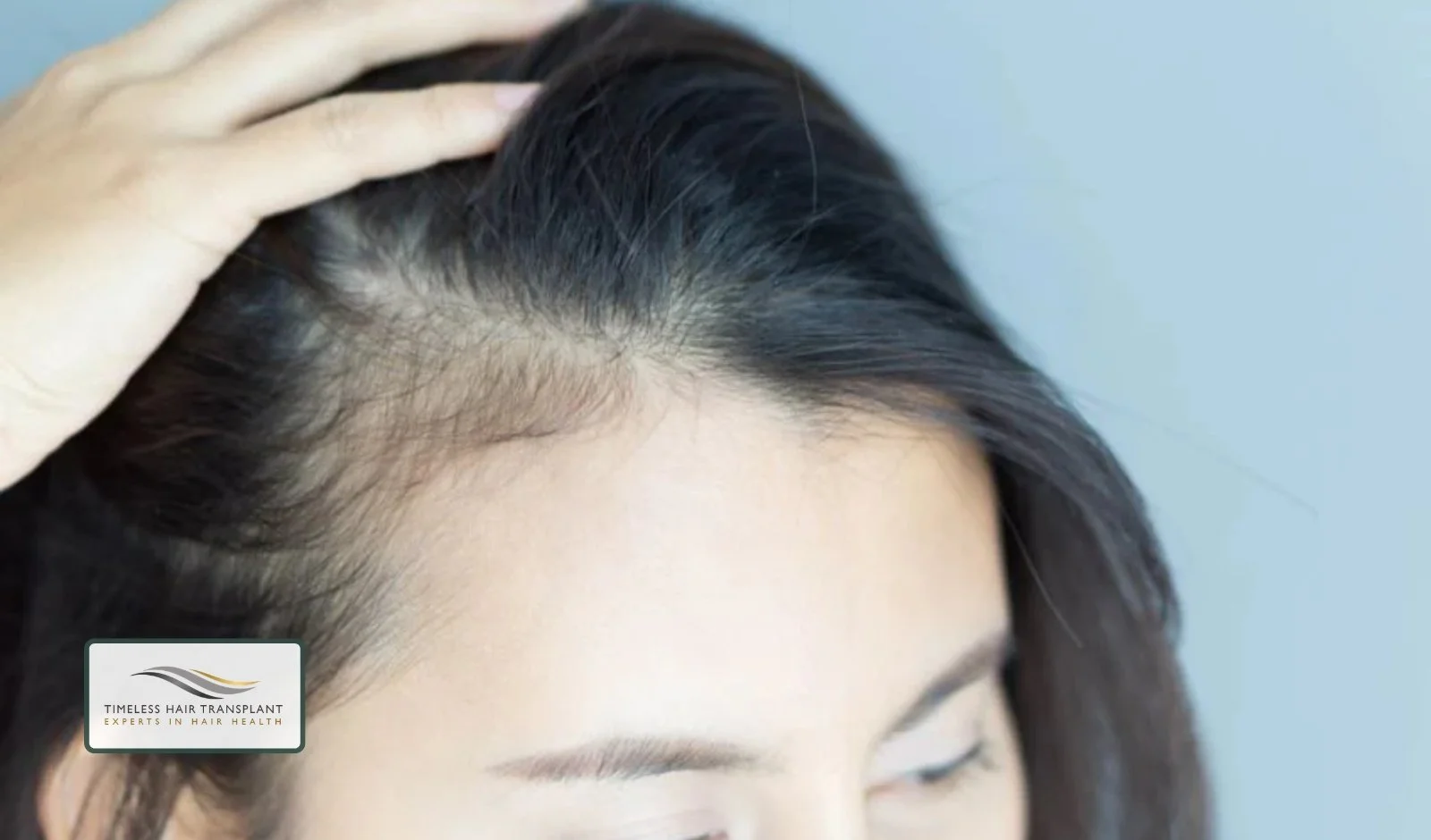 Common Causes of Receding Hairlines in Women
