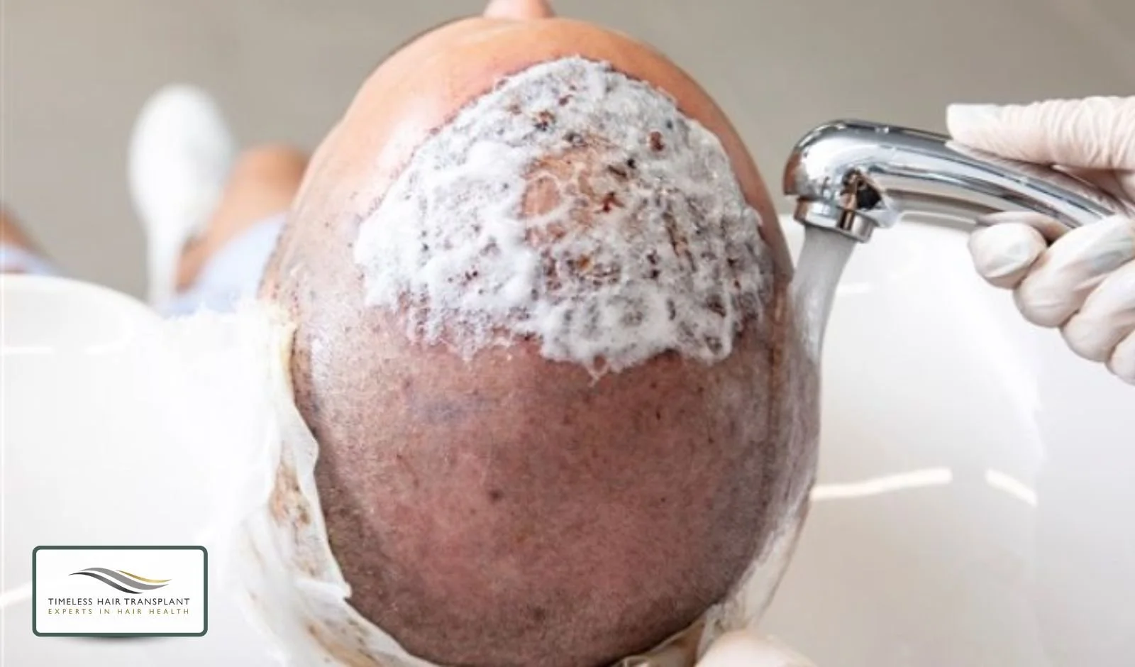 Shampoo Choice After FUE Hair Transplant