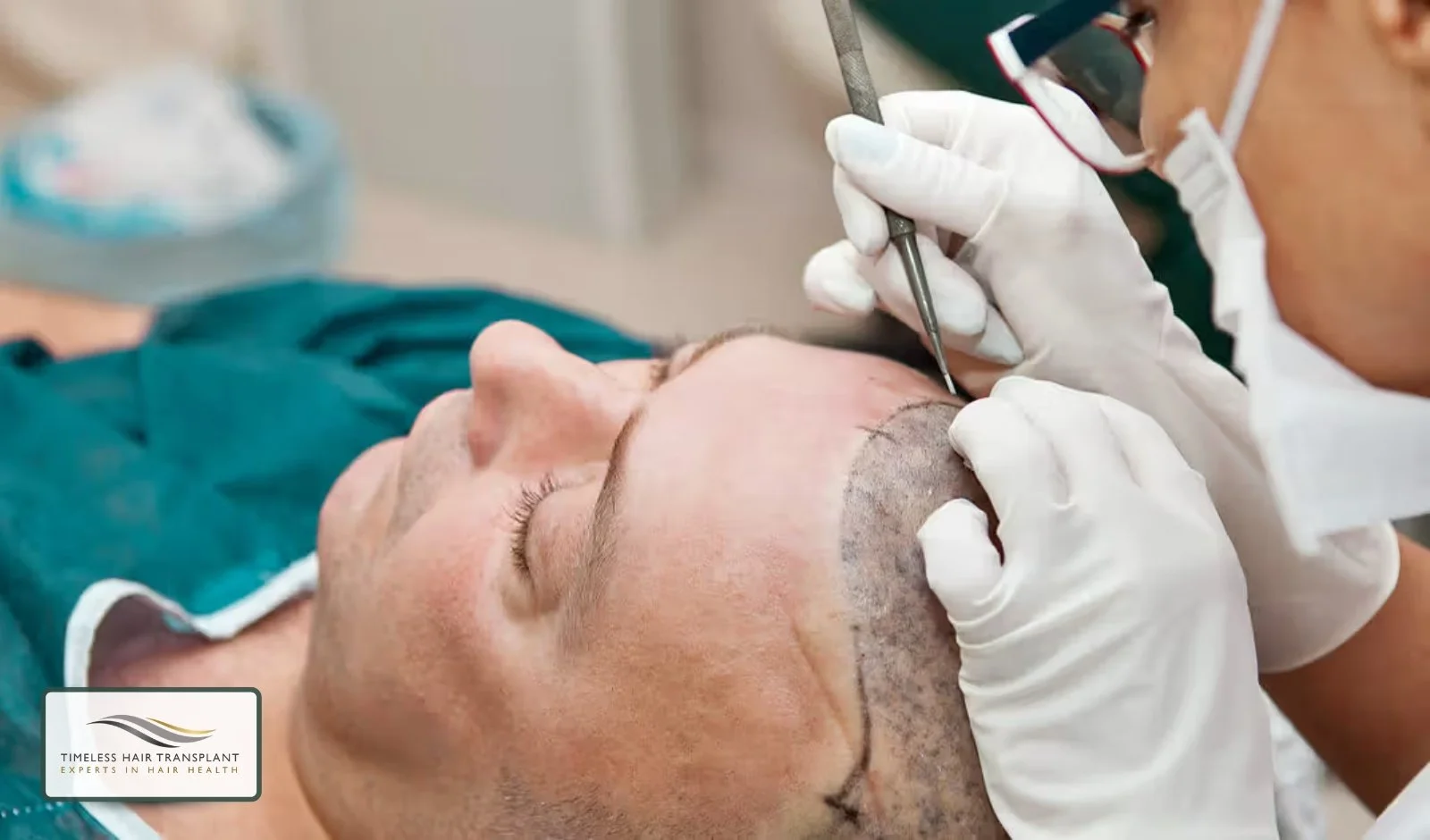 Is a Hair Transplant a Permanent Solution