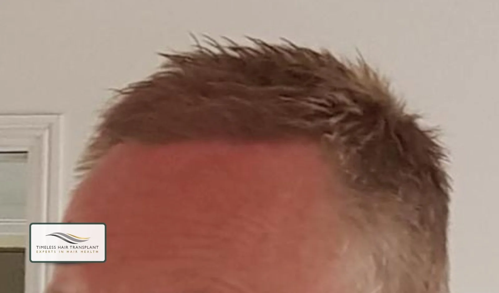 Signs the Scalp Is Healing Properly