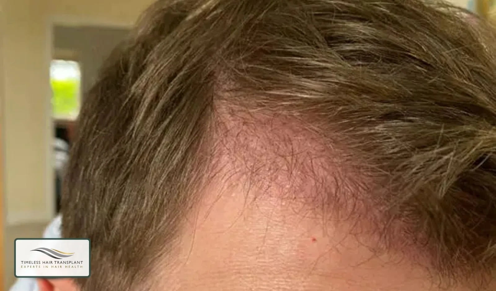 Does Shaving Affect Hair Growth