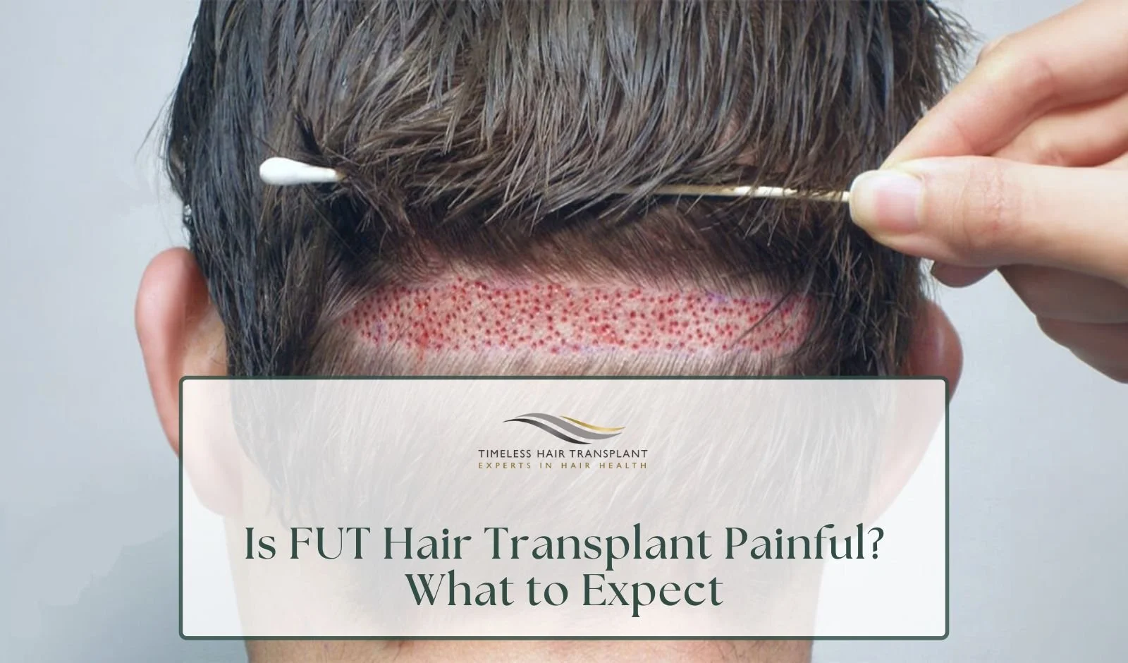Is FUT Hair Transplant Painful What to Expect