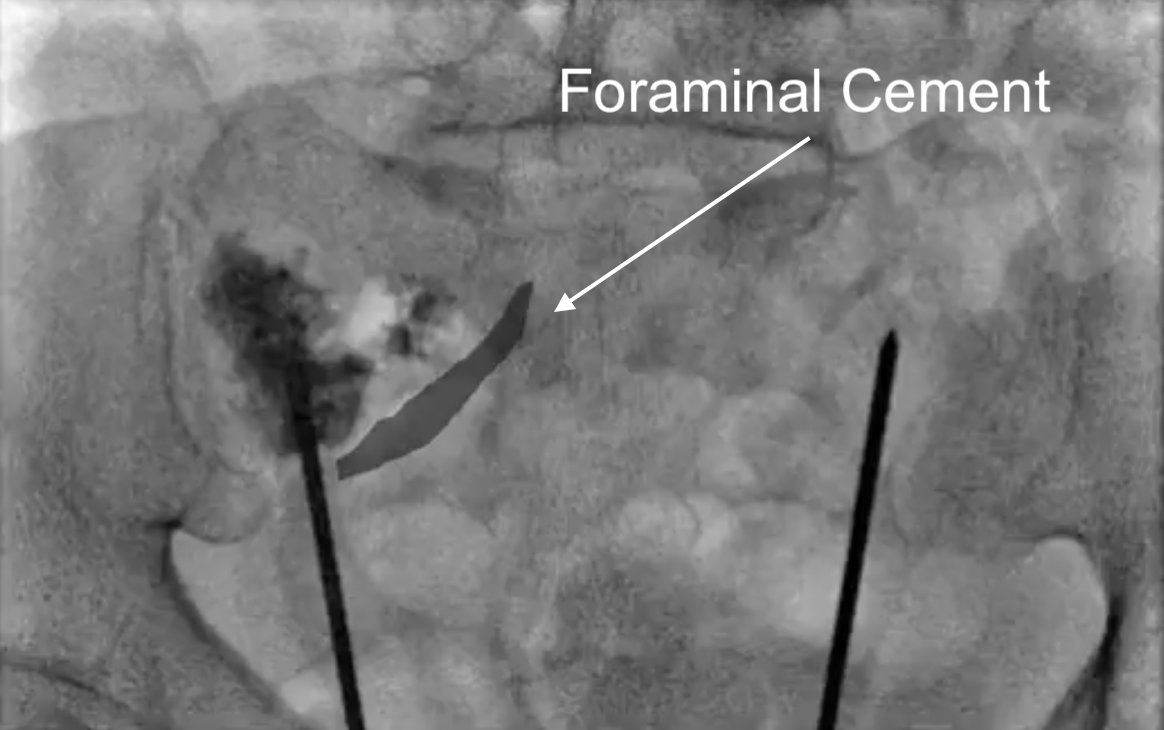 Sacroplasty — Learn IR