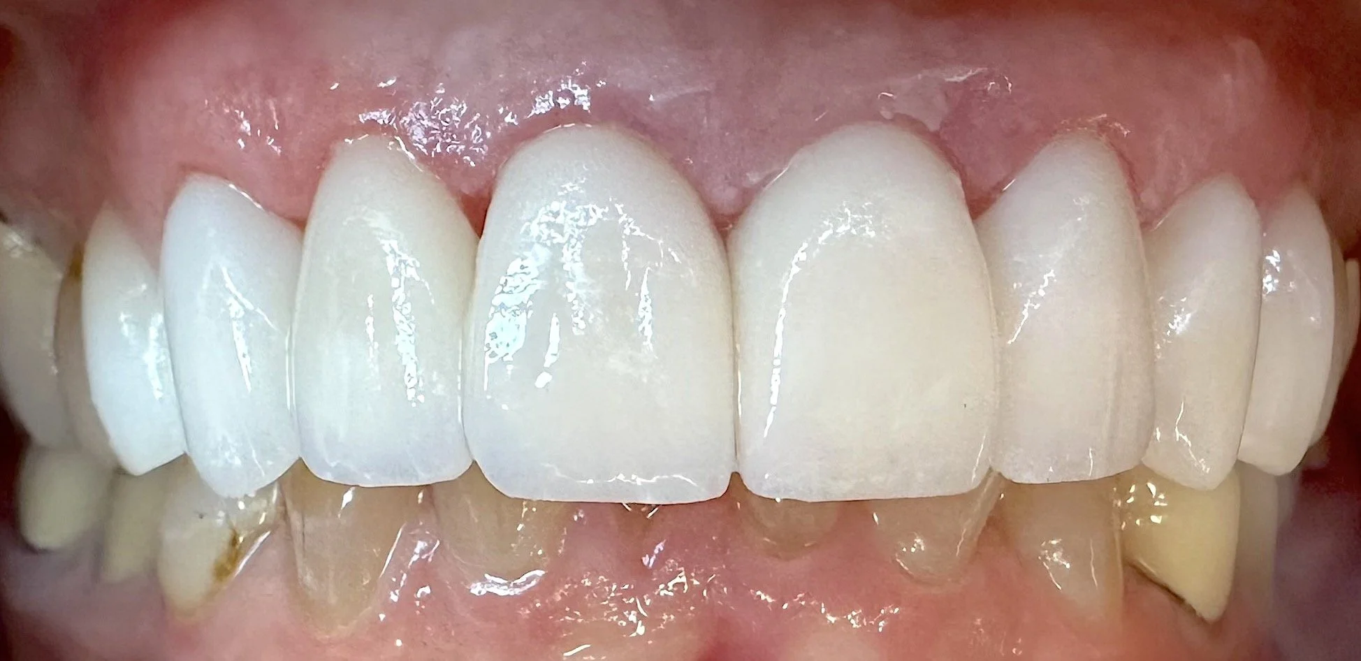 AFTER PHOTO Porcelain veneers completed by Dr. Kelly K. Thomas