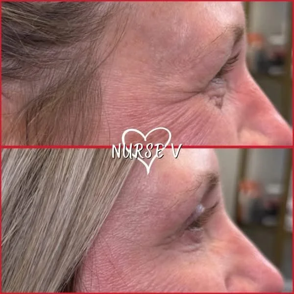 Nurse V Springfield Republic BOTOX Filler MicroNeedling Chemical peels Kybella Spider Veins Skin Care Supplements 