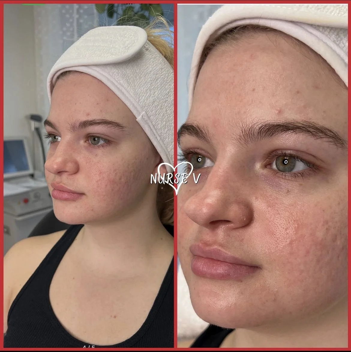 Nurse V Springfield Republic BOTOX Filler MicroNeedling Chemical peels Kybella Spider Veins Skin Care Supplements IV Vitamin infusions and IV injectables Lipo-c b-12 weightloss wrinkles volume lip filler cheek filler jaw filler chin filler 