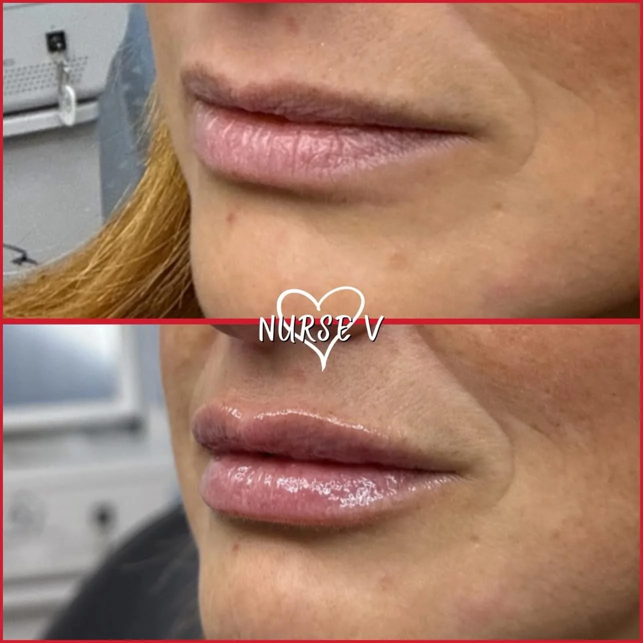 Nurse V Springfield Republic BOTOX Filler MicroNeedling Chemical peels Kybella Spider Veins Skin Care Supplements IV Vitamin infusions and IV injectables Lipo-c b-12 weightloss wrinkles volume lip filler cheek filler jaw filler chin filler 