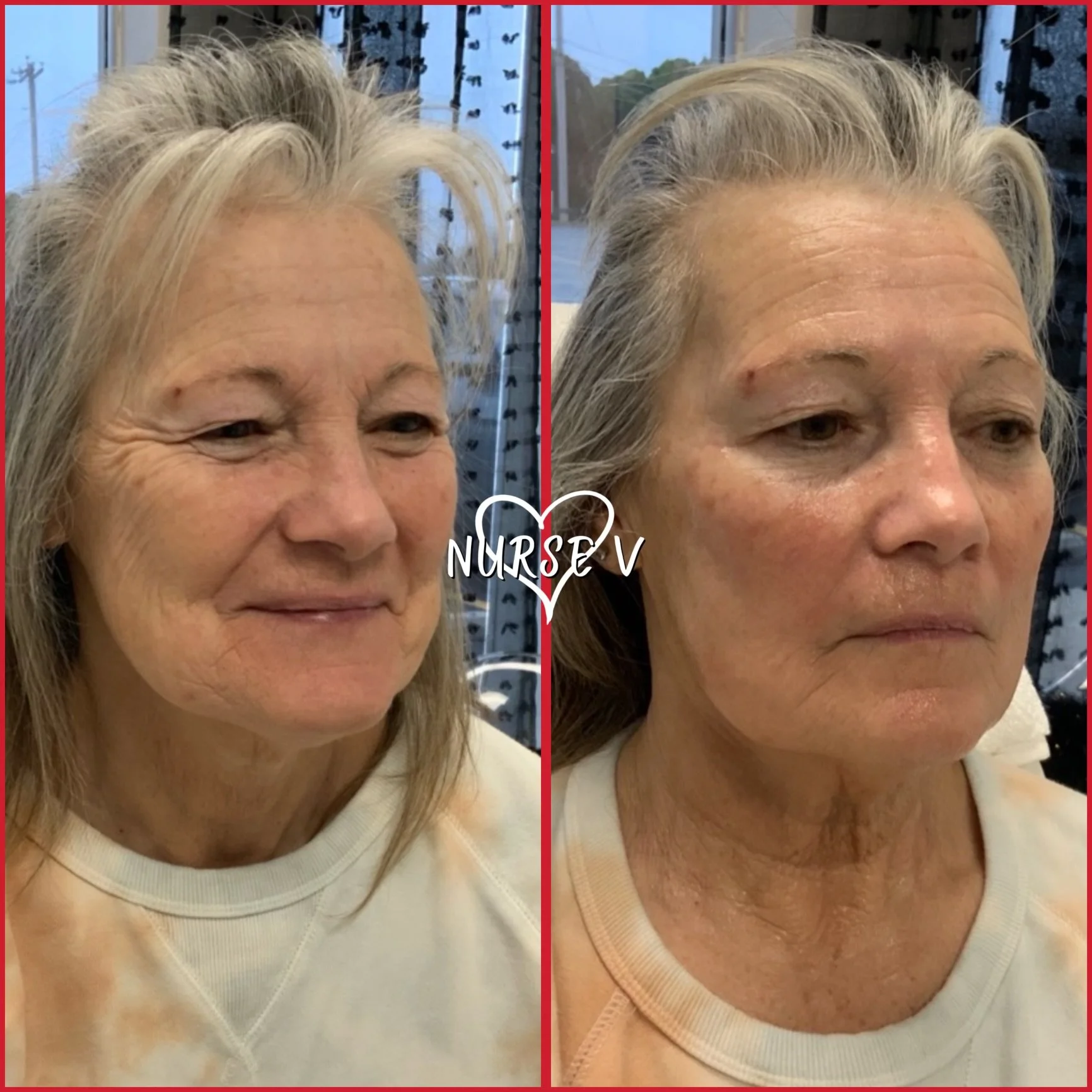 Side-by-side photos of an older woman before and after a cosmetic treatment, showing facial skin improvements