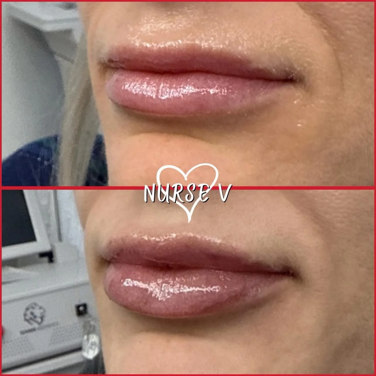 Nurse V Springfield Republic BOTOX Filler MicroNeedling Chemical peels Kybella Spider Veins Skin Care Supplements IV Vitamin infusions and IV injectables Lipo-c b-12 weightloss wrinkles volume lip filler cheek filler jaw filler chin filler 