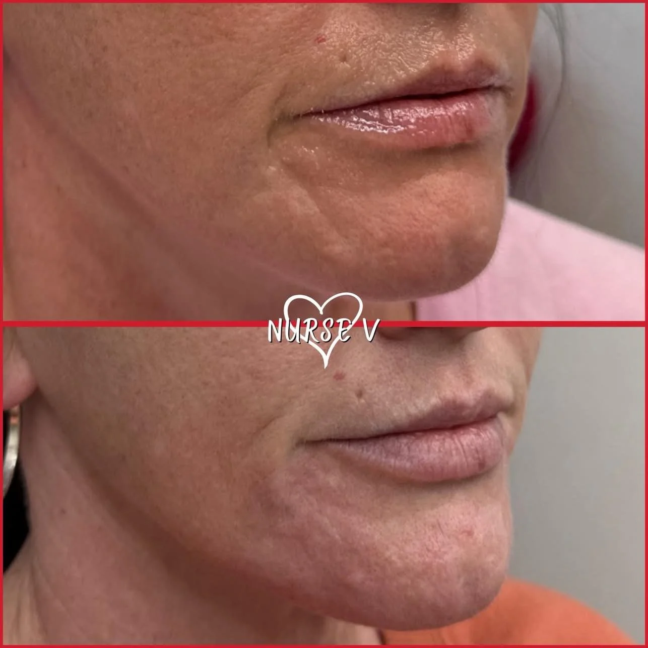 Nurse V Springfield Republic BOTOX Filler MicroNeedling Chemical peels Kybella Spider Veins Skin Care Supplements IV Vitamin infusions and IV injectables Lipo-c b-12 weightloss wrinkles volume lip filler cheek filler jaw filler chin filler 