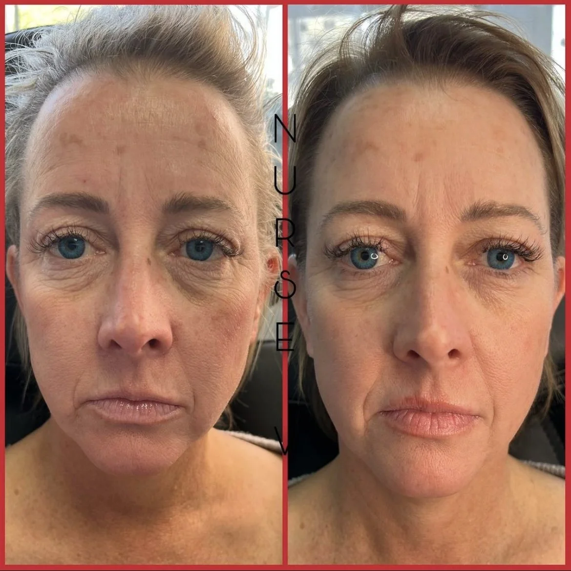 Nurse V Springfield Republic BOTOX Filler MicroNeedling Chemical peels Kybella Spider Veins Skin Care Supplements IV Vitamin infusions and IV injectables Lipo-c b-12 weightloss wrinkles volume lip filler cheek filler jaw filler chin filler 