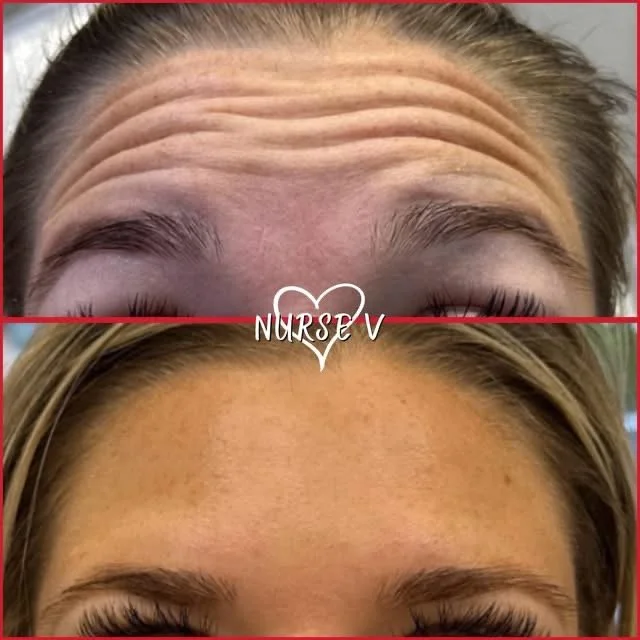 Nurse V Springfield Republic BOTOX Filler MicroNeedling Chemical peels Kybella Spider Veins Skin Care Supplements 