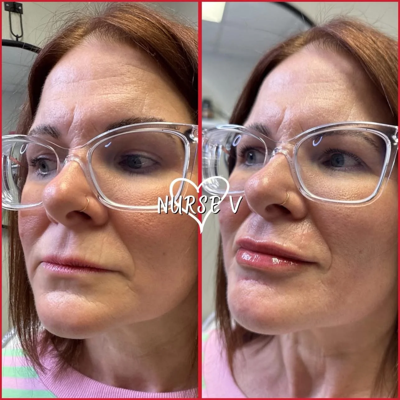 Nurse V Springfield Republic BOTOX Filler MicroNeedling Chemical peels Kybella Spider Veins Skin Care Supplements IV Vitamin infusions and IV injectables Lipo-c b-12 weightloss wrinkles volume lip filler cheek filler jaw filler chin filler 