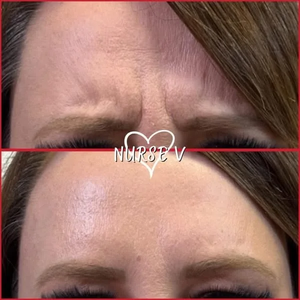 Nurse V Springfield Republic BOTOX Filler MicroNeedling Chemical peels Kybella Spider Veins Skin Care Supplements 