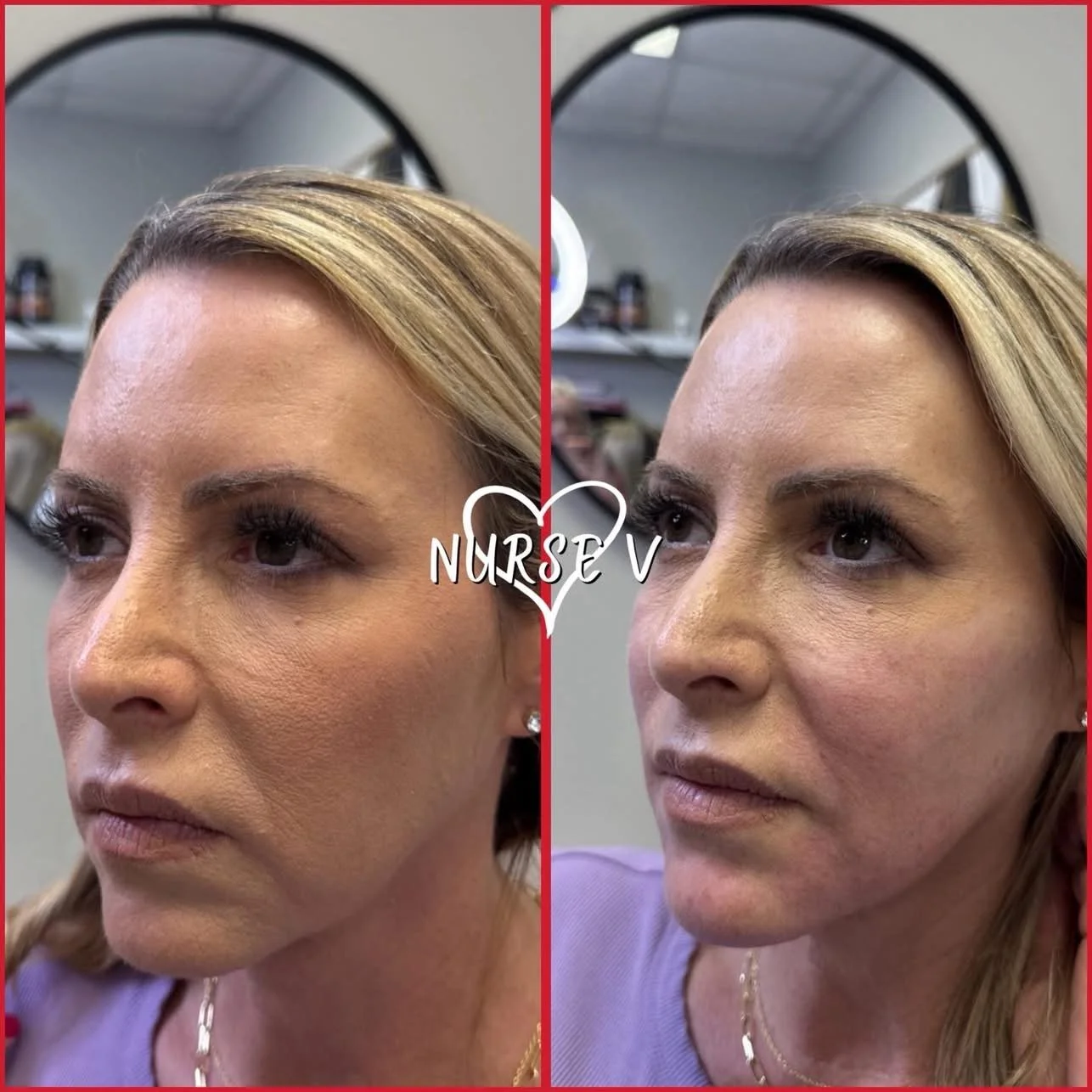 Nurse V Springfield Republic BOTOX Filler MicroNeedling Chemical peels Kybella Spider Veins Skin Care Supplements IV Vitamin infusions and IV injectables Lipo-c b-12 weightloss wrinkles volume lip filler cheek filler jaw filler chin filler 