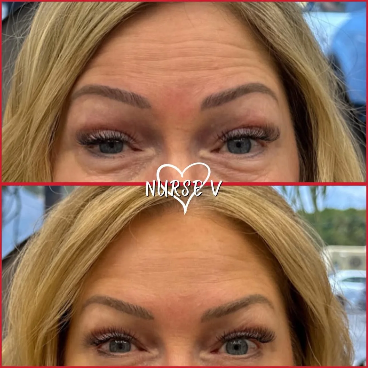 Nurse V Springfield Republic BOTOX Filler MicroNeedling Chemical peels Kybella Spider Veins Skin Care Supplements 