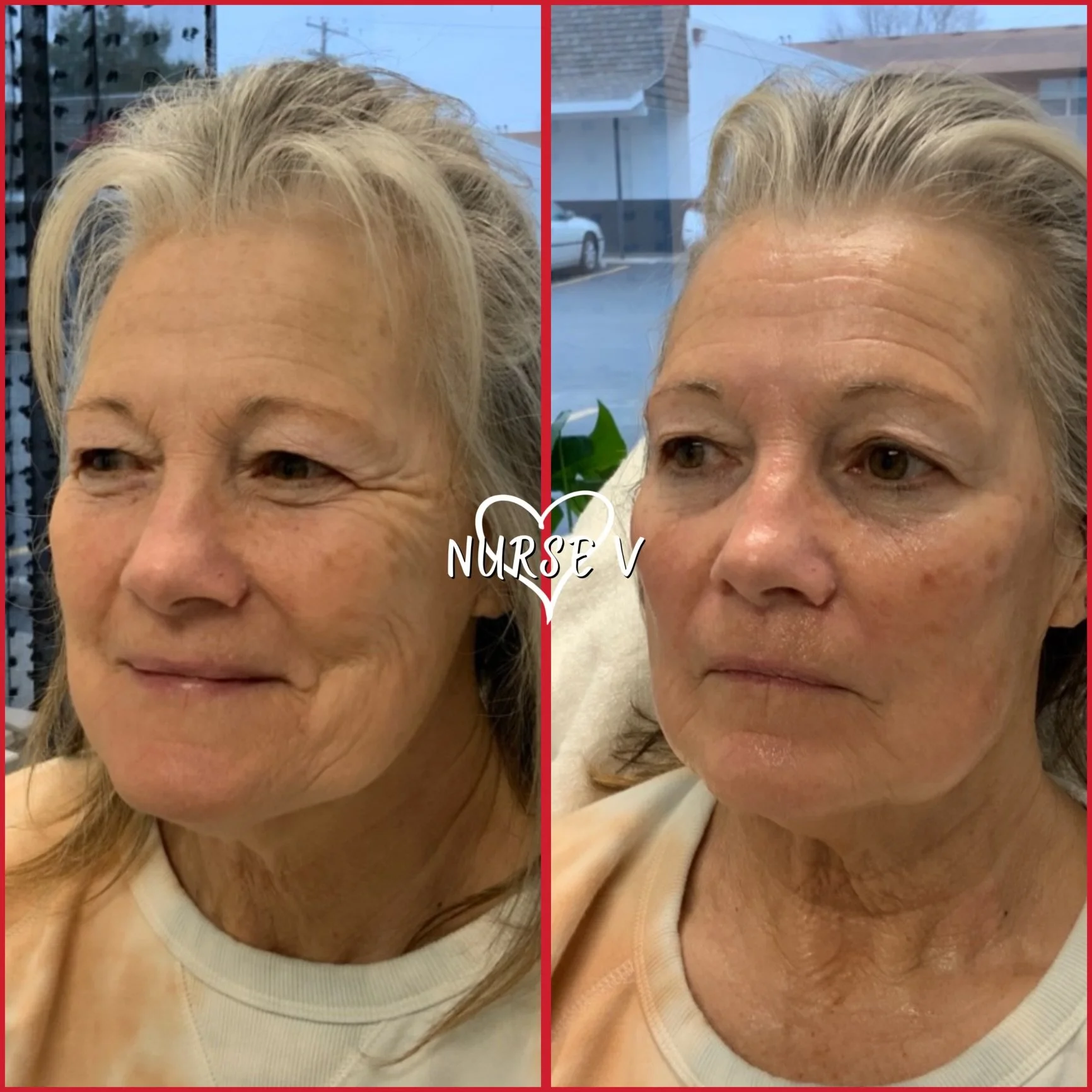 Side-by-side photos of a middle-aged woman before and after skincare treatment. The left image shows her with smoother, less wrinkled skin, while the right image shows her with slightly more textured skin. The woman has blonde hair and is wearing a white top.