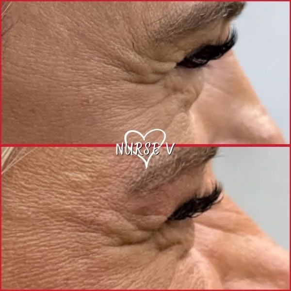 Nurse V Springfield Republic BOTOX Filler MicroNeedling Chemical peels Kybella Spider Veins Skin Care Supplements 