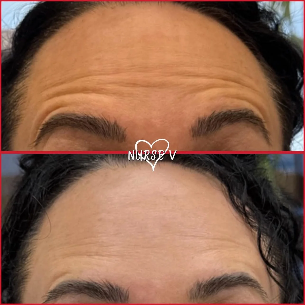 Nurse V Springfield Republic BOTOX Filler MicroNeedling Chemical peels Kybella Spider Veins Skin Care Supplements 