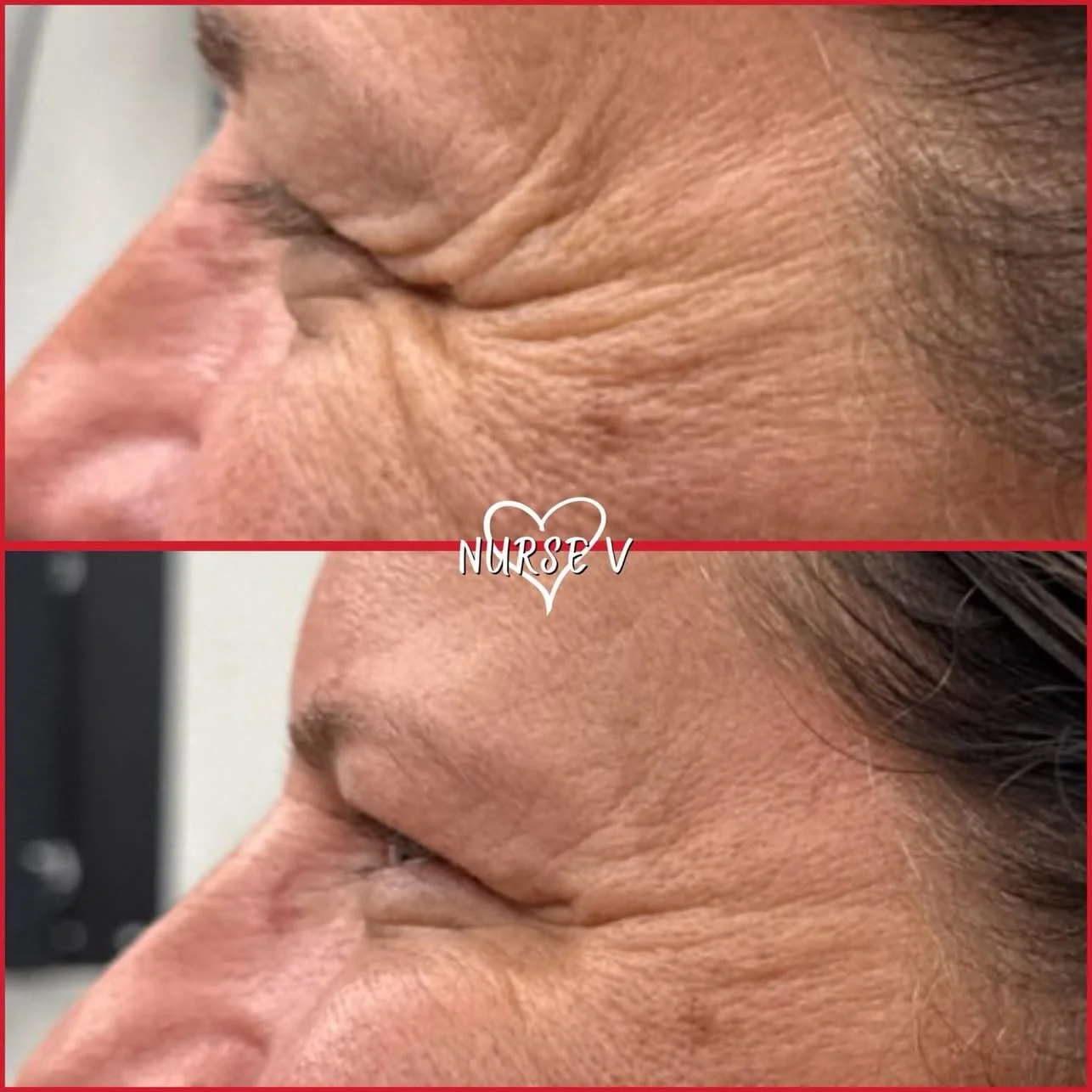 Nurse V Springfield Republic BOTOX Filler MicroNeedling Chemical peels Kybella Spider Veins Skin Care Supplements 