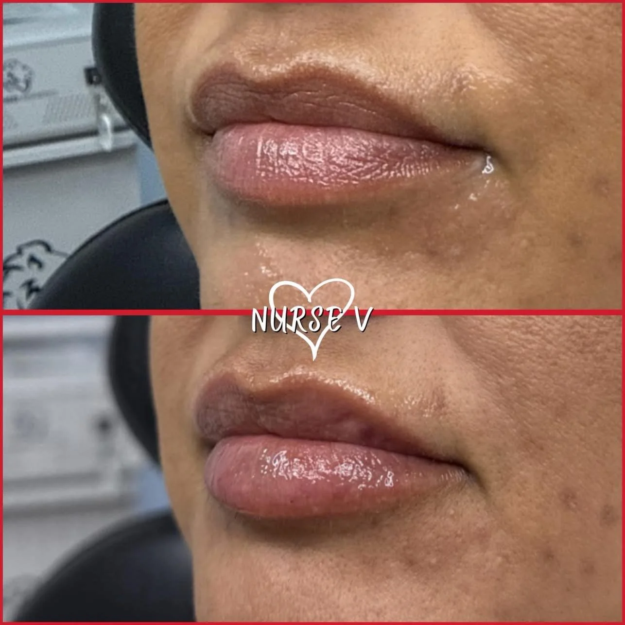 Nurse V Springfield Republic BOTOX Filler MicroNeedling Chemical peels Kybella Spider Veins Skin Care Supplements IV Vitamin infusions and IV injectables Lipo-c b-12 weightloss wrinkles volume lip filler cheek filler jaw filler chin filler 