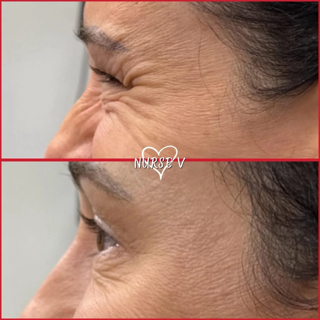 Nurse V Springfield Republic BOTOX Filler MicroNeedling Chemical peels Kybella Spider Veins Skin Care Supplements 