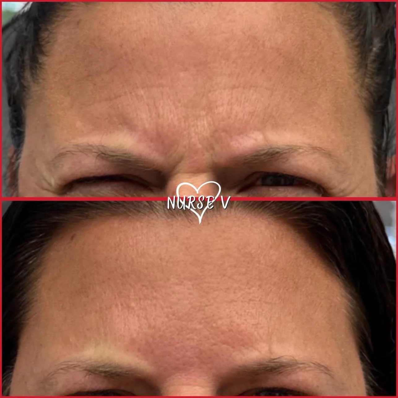 Nurse V Springfield Republic BOTOX Filler MicroNeedling Chemical peels Kybella Spider Veins Skin Care Supplements 