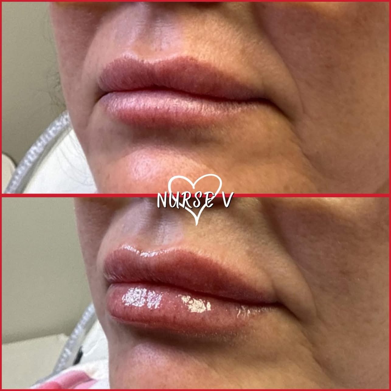 Nurse V Springfield Republic BOTOX Filler MicroNeedling Chemical peels Kybella Spider Veins Skin Care Supplements IV Vitamin infusions and IV injectables Lipo-c b-12 weightloss wrinkles volume lip filler cheek filler jaw filler chin filler 