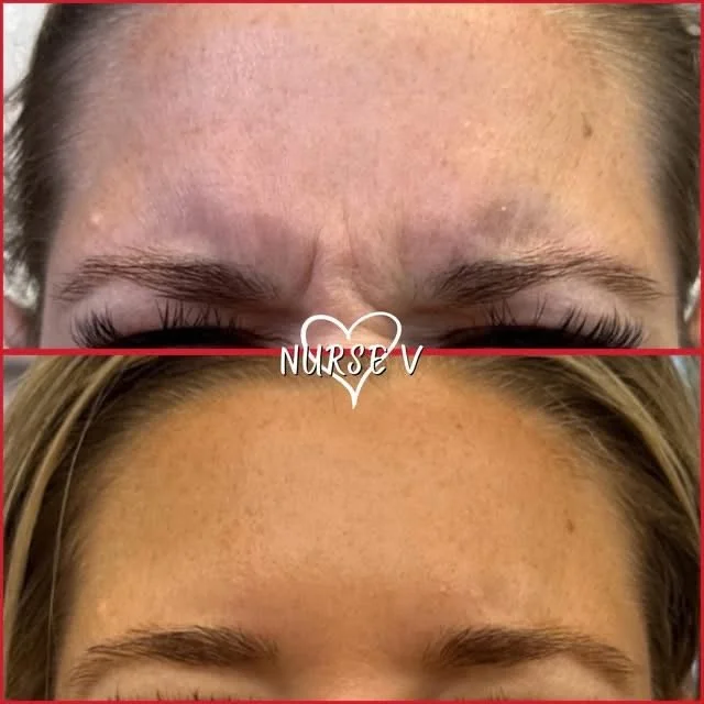Before and after images of a woman at a skincare clinic. The left image shows her with makeup, sunglasses on her head, and smoothened skin. The right image shows her without makeup, revealing natural freckles, redness, and skin texture.