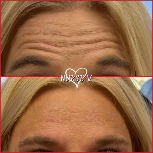 Nurse V Springfield Republic BOTOX Filler MicroNeedling Chemical peels Kybella Spider Veins Skin Care Supplements 