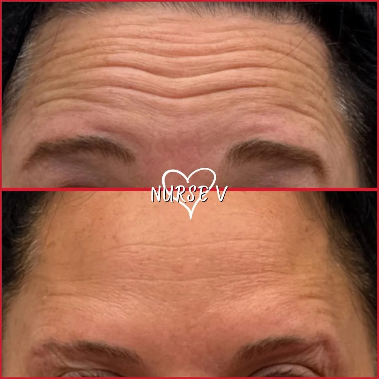 Nurse V Springfield Republic BOTOX Filler MicroNeedling Chemical peels Kybella Spider Veins Skin Care Supplements 