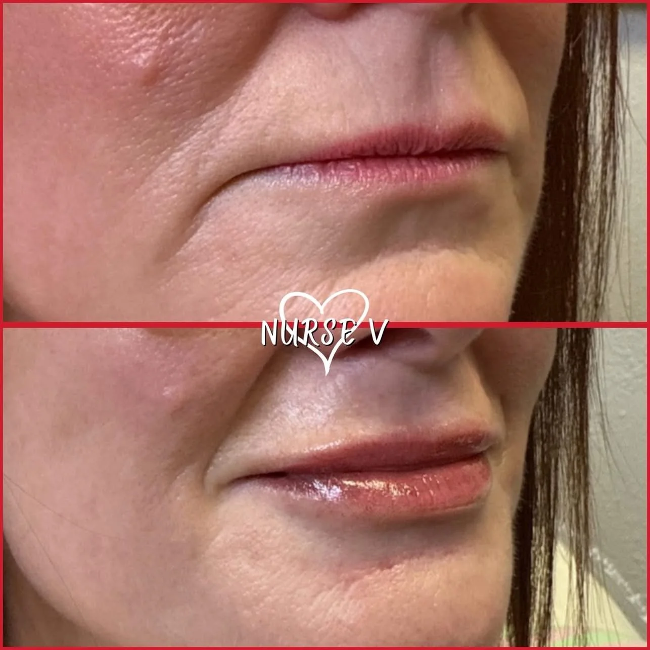 Nurse V Springfield Republic BOTOX Filler MicroNeedling Chemical peels Kybella Spider Veins Skin Care Supplements IV Vitamin infusions and IV injectables Lipo-c b-12 weightloss wrinkles volume lip filler cheek filler jaw filler chin filler 