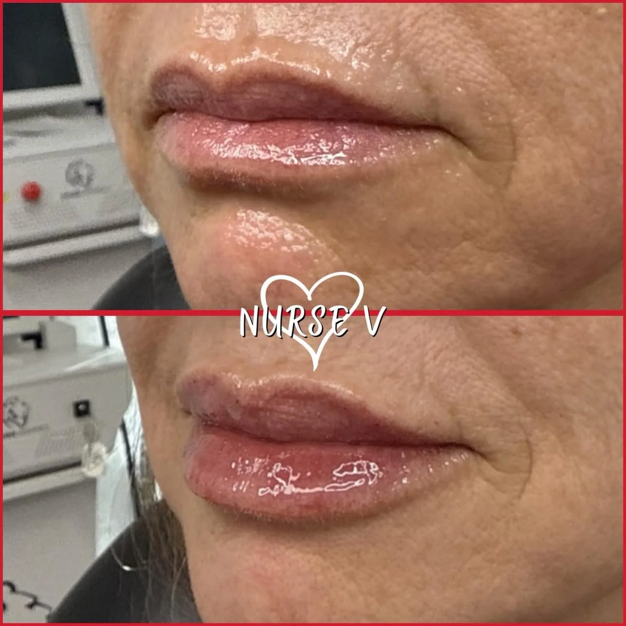 Nurse V Springfield Republic BOTOX Filler MicroNeedling Chemical peels Kybella Spider Veins Skin Care Supplements IV Vitamin infusions and IV injectables Lipo-c b-12 weightloss wrinkles volume lip filler cheek filler jaw filler chin filler 