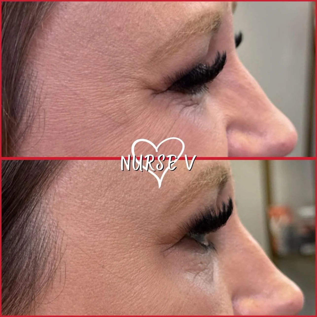 Nurse V Springfield Republic BOTOX Filler MicroNeedling Chemical peels Kybella Spider Veins Skin Care Supplements 