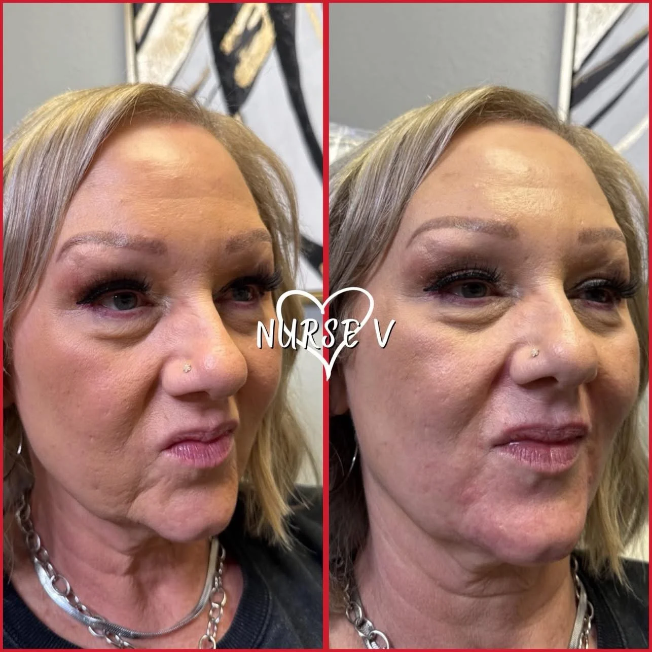Nurse V Springfield Republic BOTOX Filler MicroNeedling Chemical peels Kybella Spider Veins Skin Care Supplements IV Vitamin infusions and IV injectables Lipo-c b-12 weightloss wrinkles volume lip filler cheek filler jaw filler chin filler 