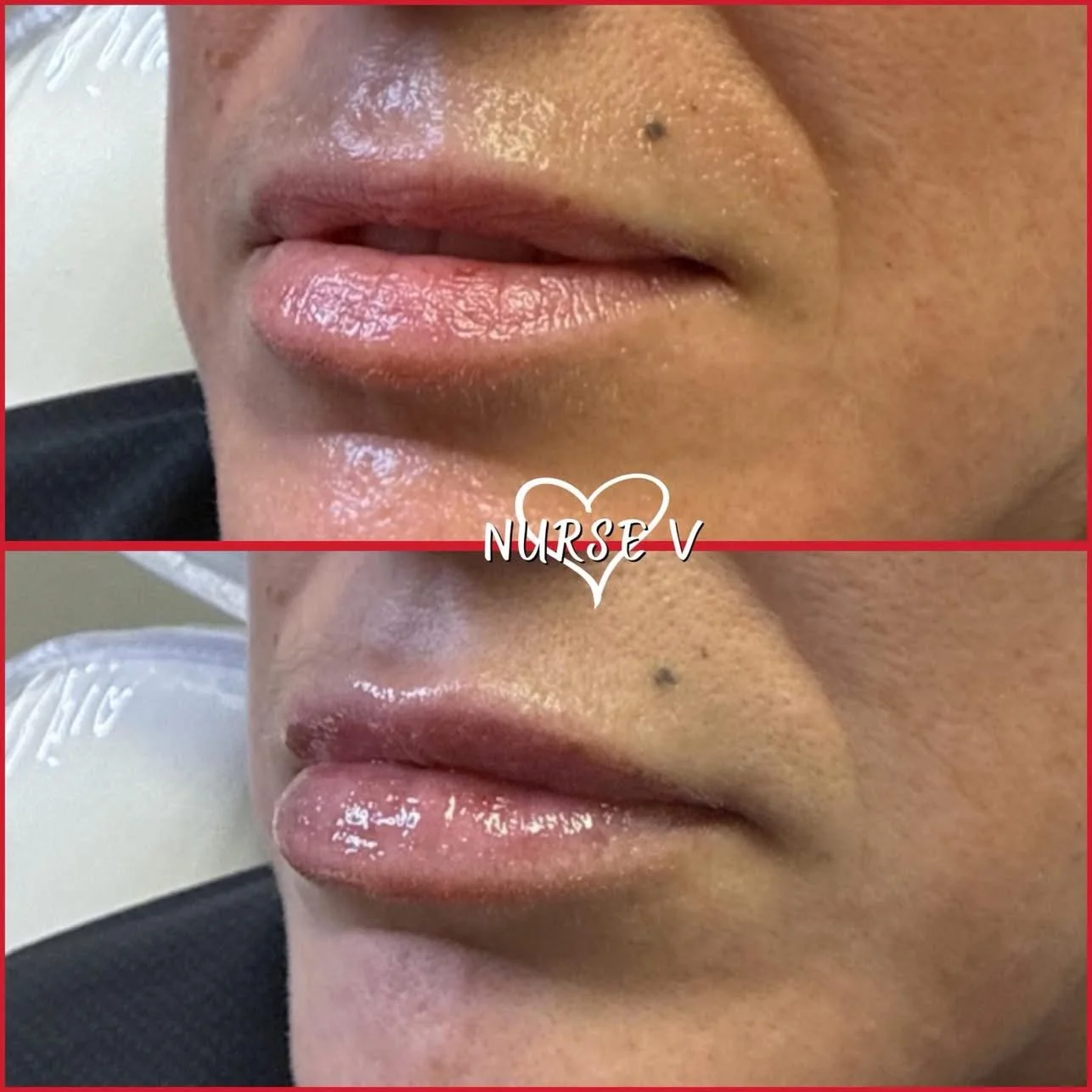 Nurse V Springfield Republic BOTOX Filler MicroNeedling Chemical peels Kybella Spider Veins Skin Care Supplements IV Vitamin infusions and IV injectables Lipo-c b-12 weightloss wrinkles volume lip filler cheek filler jaw filler chin filler 