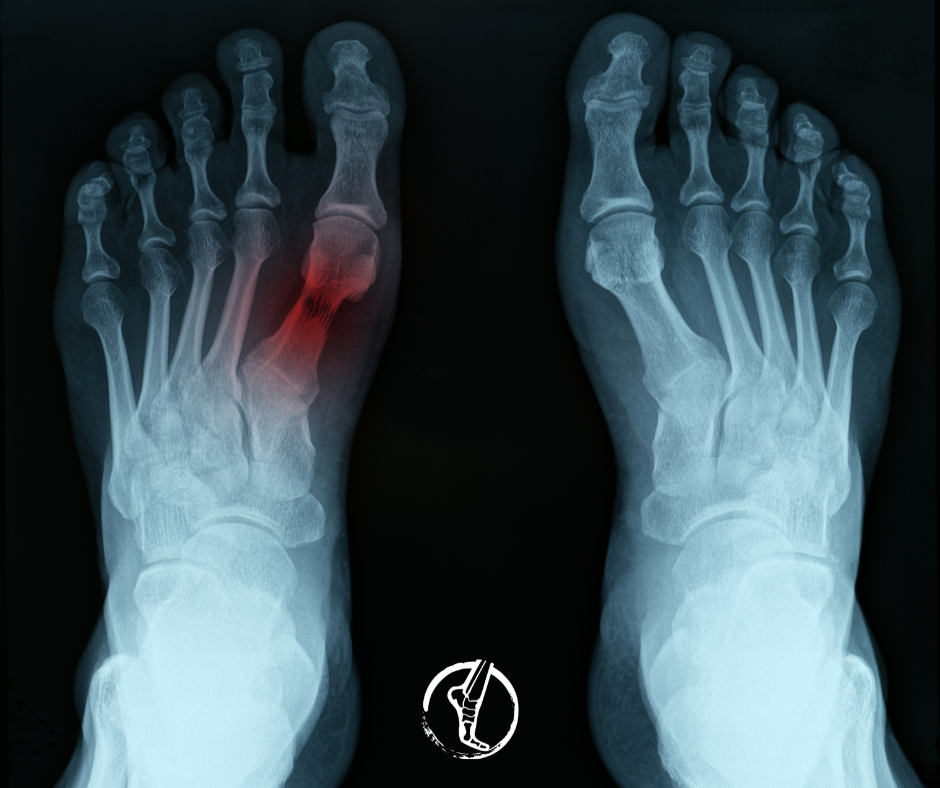 Metatarsal Stress Response