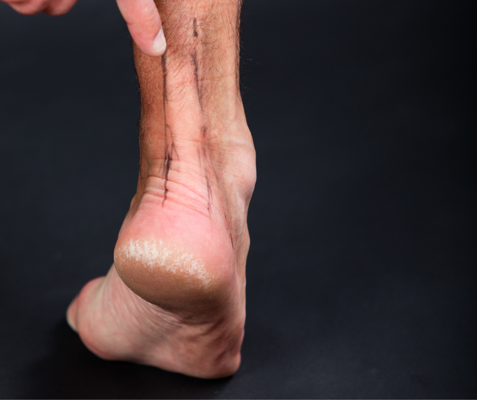 How to Cure Achilles Tendonitis Fast JS Podiatry