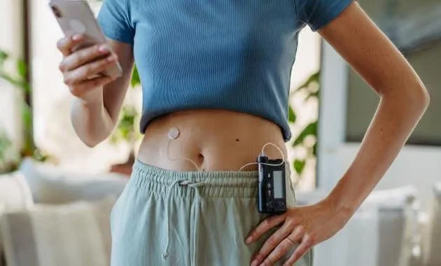 Person holding a smartphone, wearing a blue crop top and light-colored shorts, with a wearable diabetes medical devices attached to their waist.