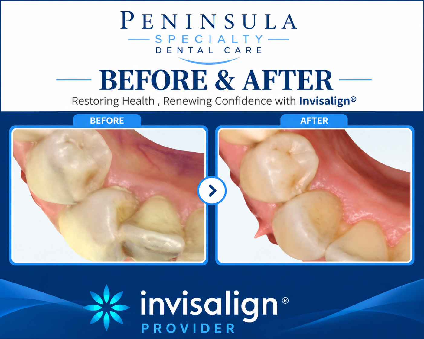 invisalign before and after.png