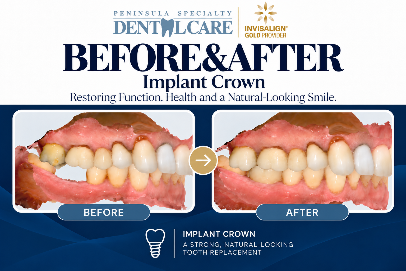 implant before and after.png