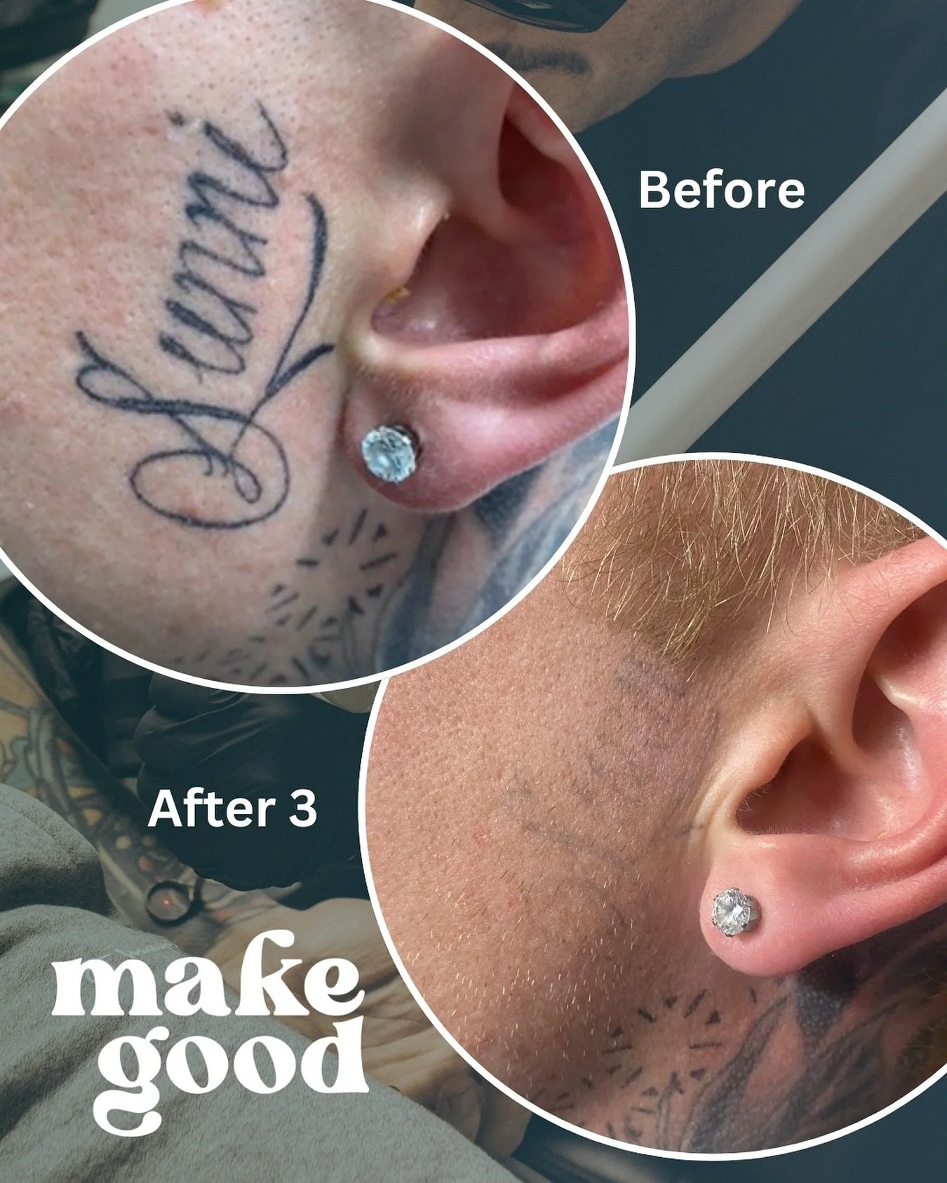 WIP⚡

Results after 3 sessions. Last zap today and this banger is long gone.✨

Face tattoos typically fade a lot faster than other parts of the body. This is due to the super high circulation in that area. 🤓

DM or contact us below for a quote and t