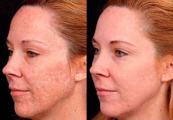 skin-aesthetic-medicine-clinic-near-me-preston-chemical-peels-exfoliation-blackheads-stretch-marks-acne-scars-hyperpigmentation-prx-t33-before-after-lancashire-pic-5.jpg