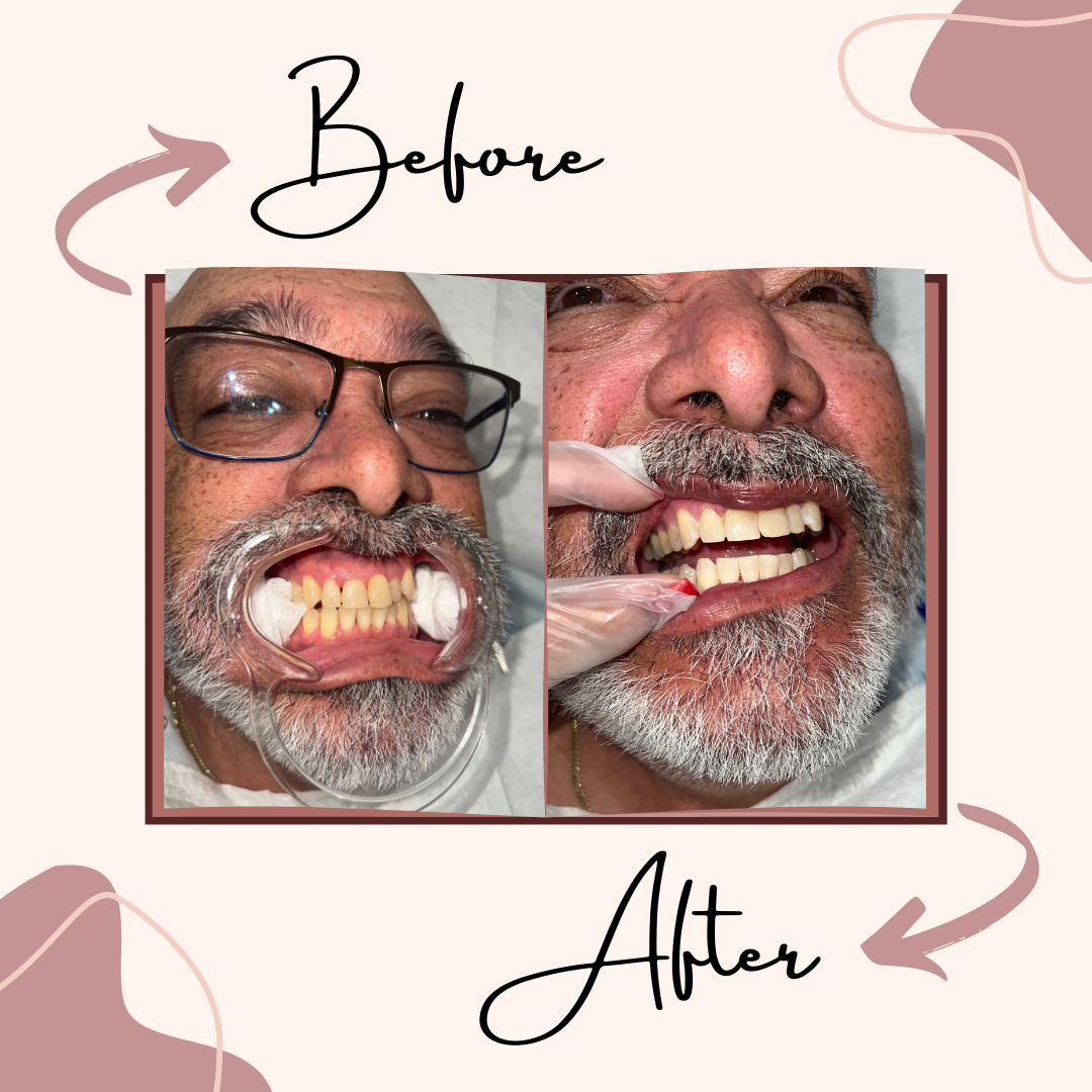 Teeth Whitening - Client 1.png