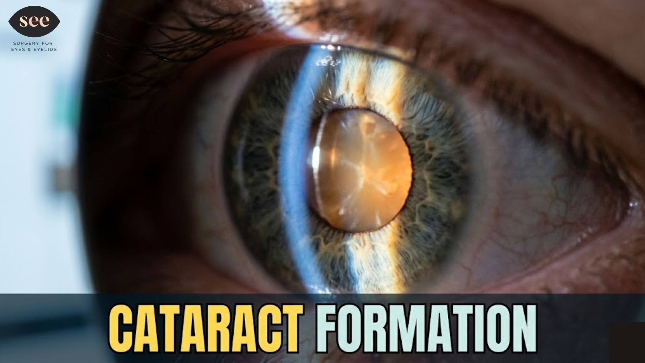 Cataract Formation