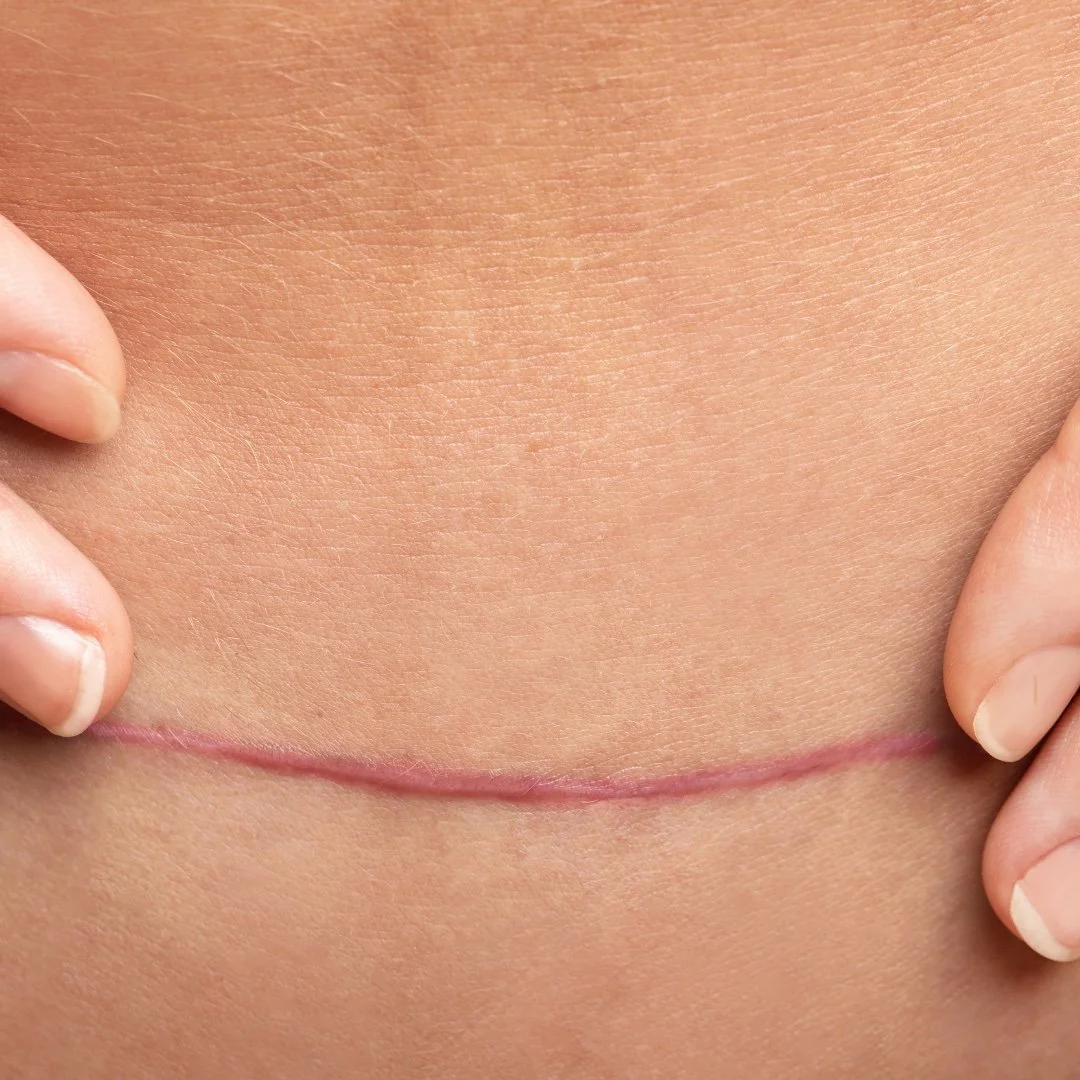 Pelvic Floor Dysfunction After C-section