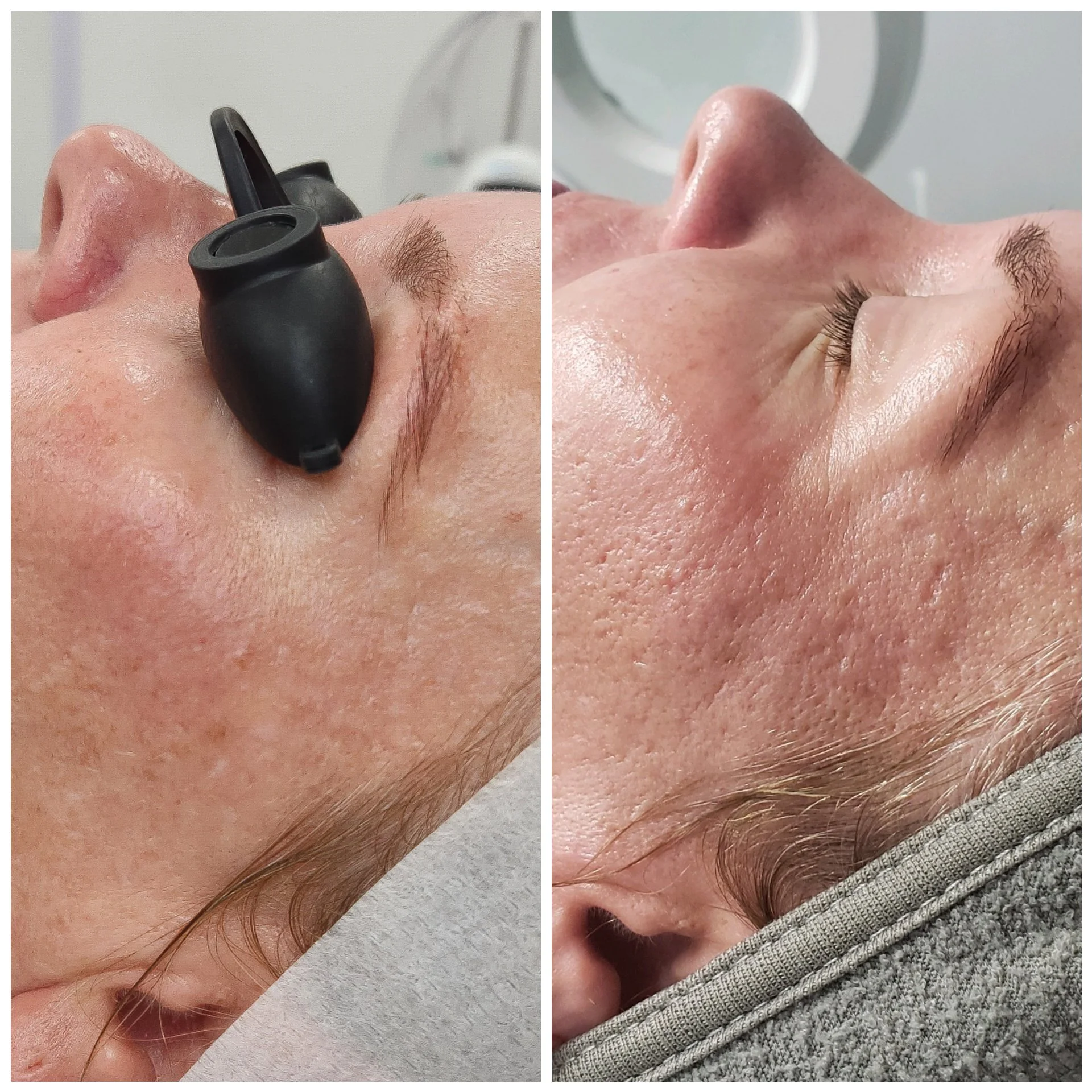 Microneedling & RF Microneedling